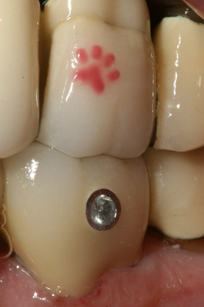 images and words, and even jewelry, on porcelain dental crowns