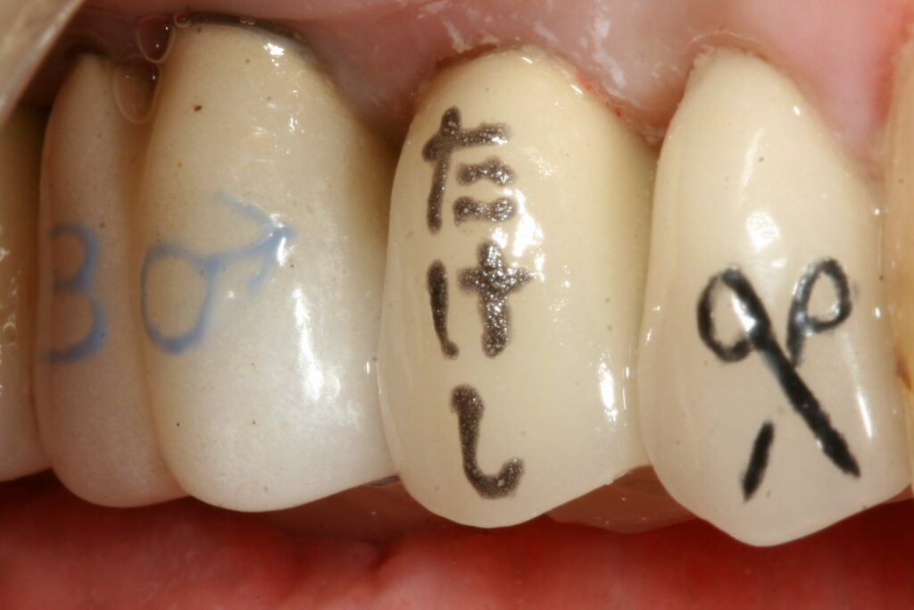 Custom porcelain crowns with text and symbols.