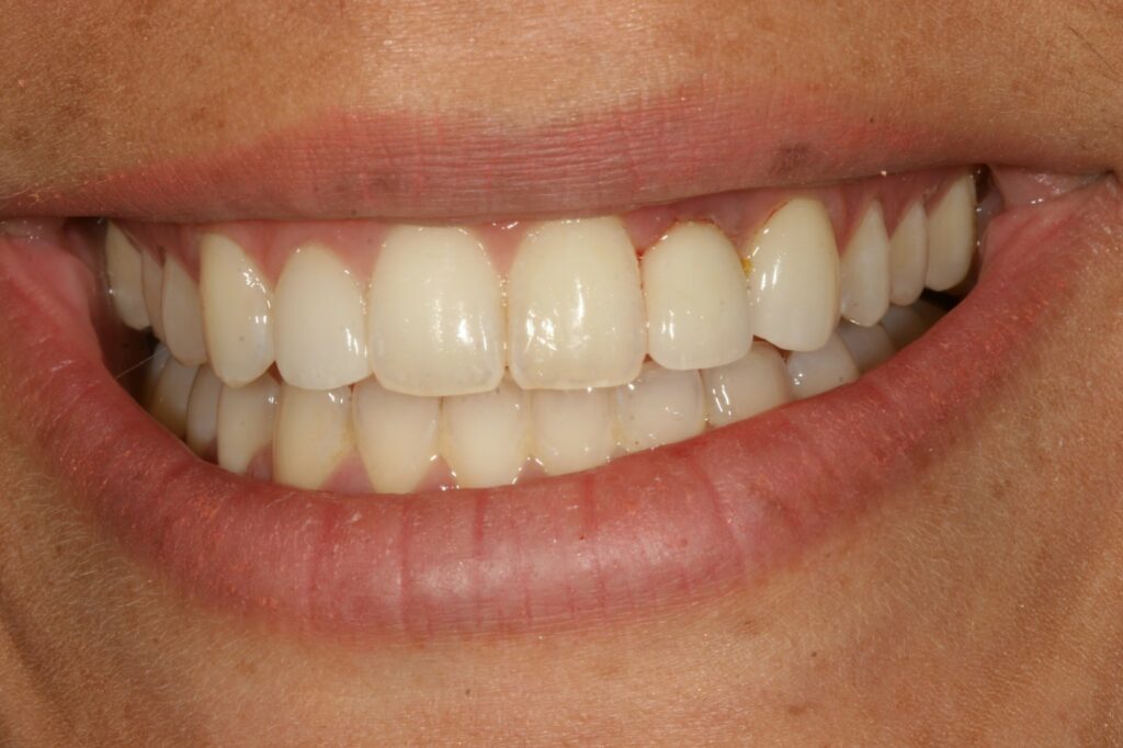 Completed porcelain crown dental implant and a new beautiful, healthy smile.