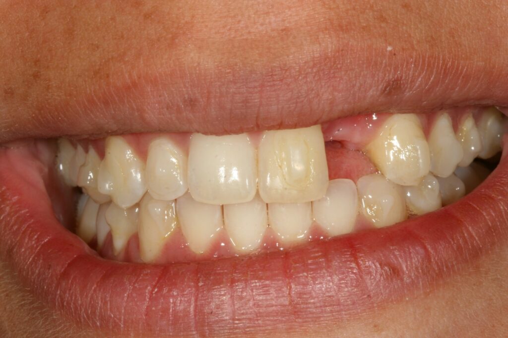 Porcelain crown dental Implant (before procedure)