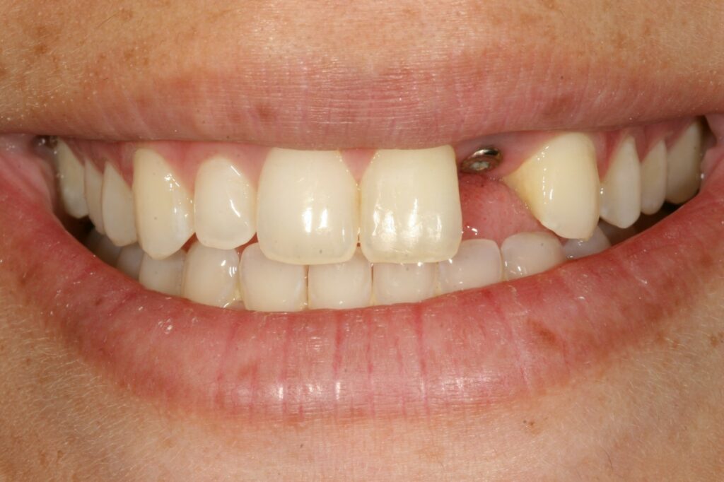 Porcelain crown dental Implant (after artificial root placement)