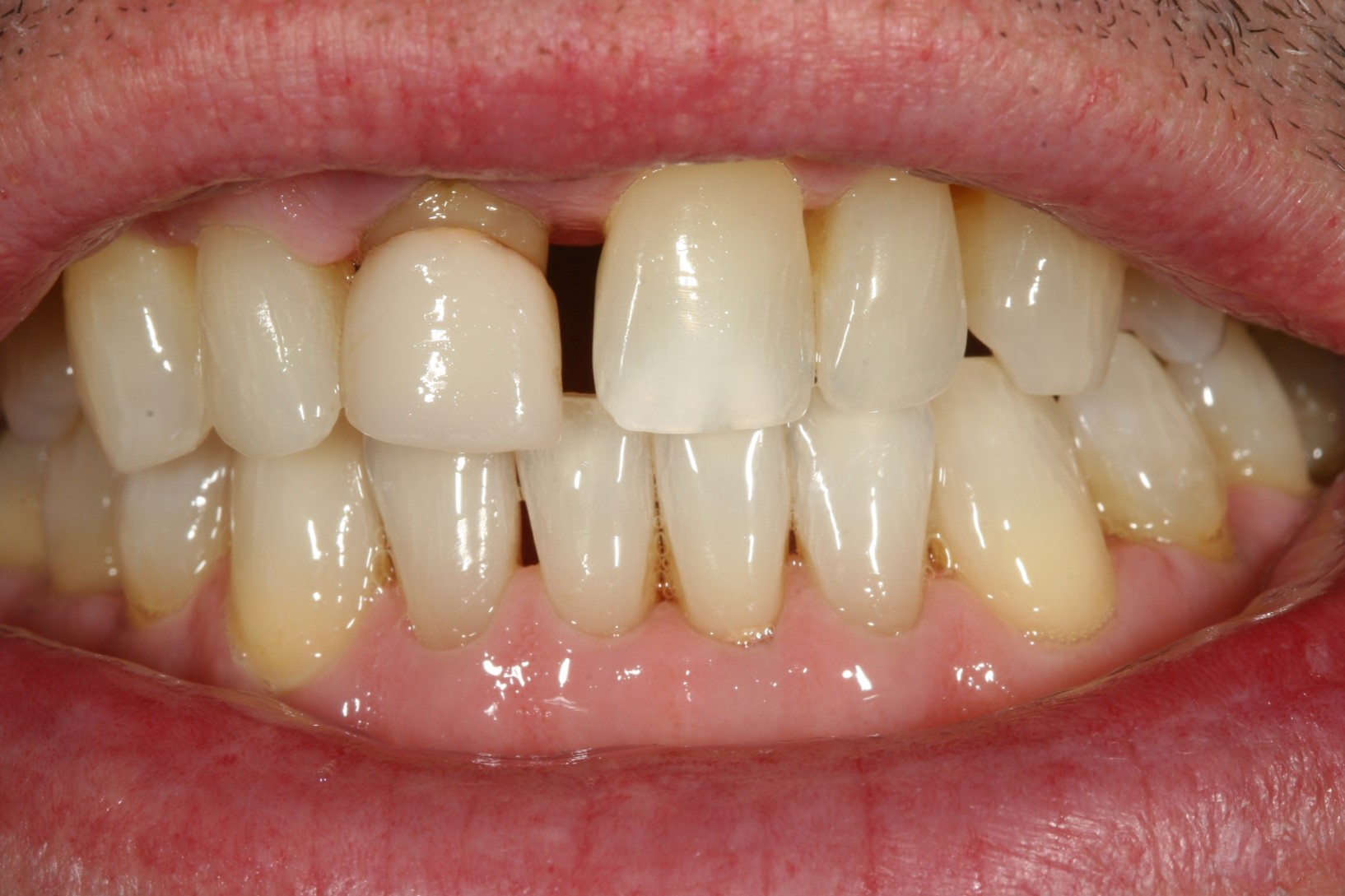 Porcelain dental crown, before