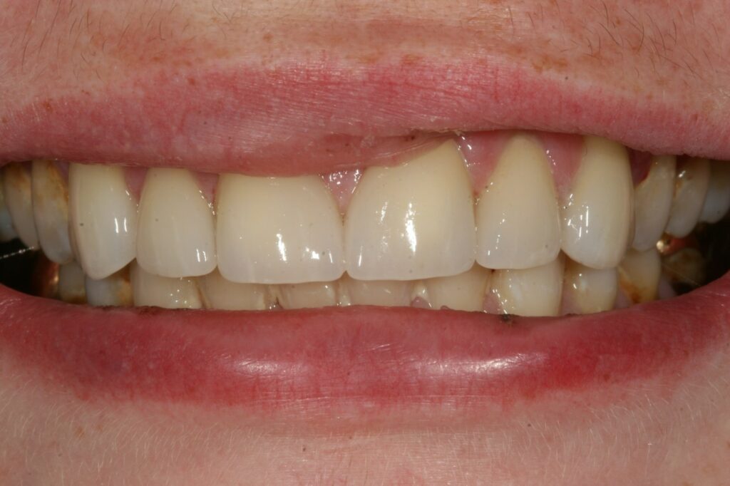 Veneers after