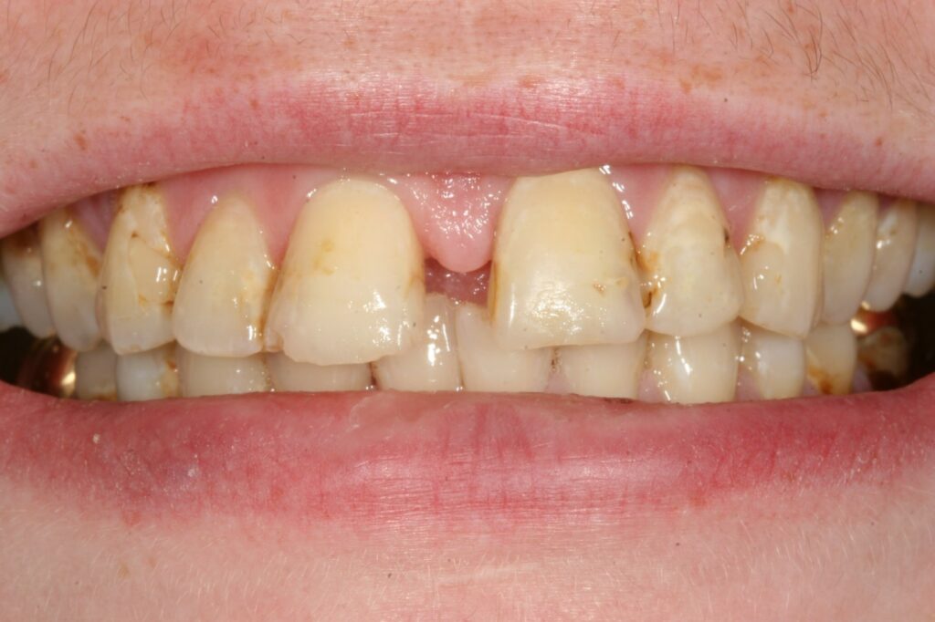 Veneers before
